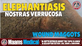 Elephantiasis Nostras Verrucosa and Wound Maggots  Rare Skin Disease [upl. by Llewej827]