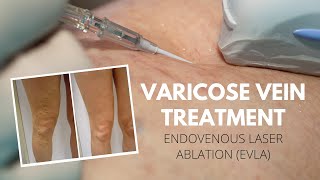 Endovenous Laser Ablation to treat Varicose Veins  Vein Health Vein Clinic [upl. by Acnalb]