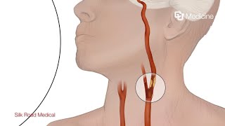 Carotid Artery Disease Risk Factors Prevention and Treatment [upl. by Avla]