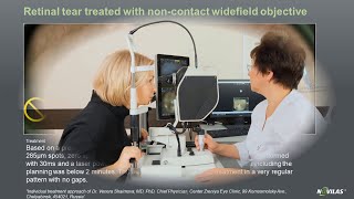 Laser retinopexy Noncontact navigated laser treatment of a retinal tear with Navilas® 577s [upl. by Ettener]