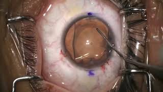 Cirugía de lente intraocular ICL para MIOPÍA y ASTIGMATISMO 🤓 [upl. by Jahdiel]