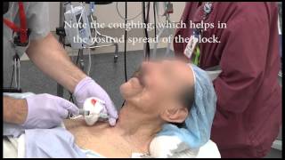 Awake intubation with the Clarus Video System from AOD rerelease [upl. by Corrie]