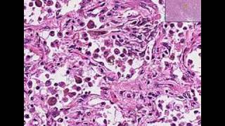 Histopathology Lung Organizing pneumonia [upl. by Obeded]