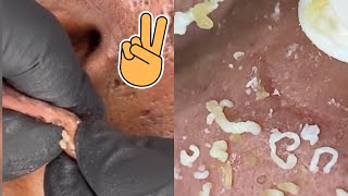 Big Cystic Acne Blackheads Extraction Blackheads amp Milia Whiteheads Removal Pimple Popping [upl. by Cirted]