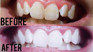 Review iSmile Teeth Whitening Kit  Amazon Finds [upl. by Hanson]