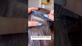 💯Easy Dandruff Removal Home Remedy Get Rid Dandruff shorts haircare hairgrowth hairfall viral [upl. by Zacarias]