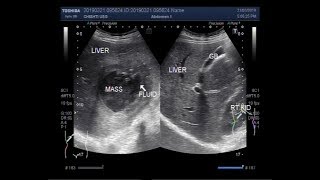 Ultrasound Video showing Amoebic liver abscess [upl. by Golightly]