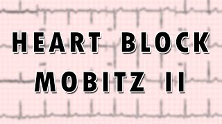 SecondDegree AV Heart Block Mobitz Type II [upl. by Rahas]