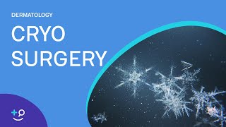 Cryo Surgery Procedure Freezing [upl. by Mendel]