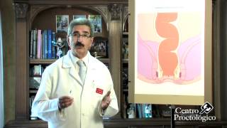 Técnicas no quirúrgicas hemorroides Escleroterapia Centro Proctológico Dr Germán Vázquez [upl. by Greenleaf]