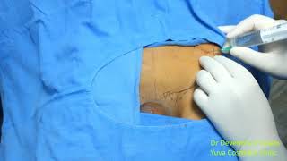 Iliohypogastric amp Ilioinguinal Nerve Block [upl. by Yetnom]