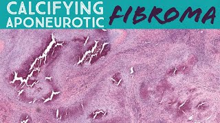 Calcifying Aponeurotic Fibroma UNC Case 5 pathology dermatopathology soft tissue tumor [upl. by Axia]