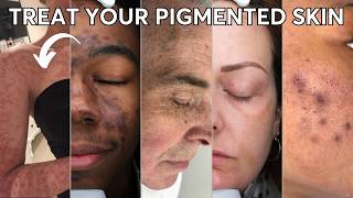 Everything You Need to Know About Pigmentation [upl. by Mast]