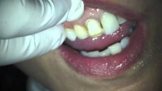 Dr Harvey Shiffman Fotona Lightwalker Dental Laser Veneer Removal [upl. by Eibbob]