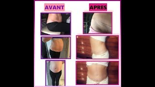 ABDOMINOPLASTIE BILAN DES 6 MOIS 👎😪😪 [upl. by Oinotnas]