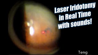 Laser Iridotomy in Real Time with Laser Sounds Chris Teng MD [upl. by Photina]