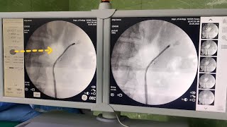 RIRS  Retrograde Intrarenal Surgery [upl. by Notyrb]