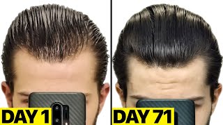 My INSANE Finasteride amp Minoxidil 25 Months Results [upl. by Kooima]