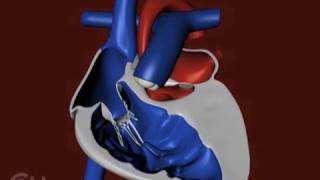 The Structure of a Heart with Hypoplastic Left Heart Syndrome HLHS  CHOP [upl. by Alleuqcaj450]