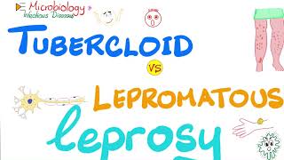 Leprosy  Tuberculoid Leprosy vs Lepromatous Leprosy  Comparisons Playlist [upl. by Einahteb]