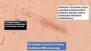 Granular casts in Urine under the Microscope [upl. by Clausen720]