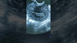 Endometrial polyp ultrasound [upl. by Sonitnatsok]