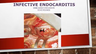 Echocardiography in infective endocarditis Casebased discussions [upl. by Elocen]