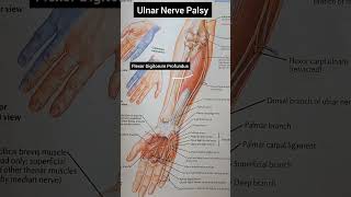 Ulnar Nerve Palsy [upl. by Patten]