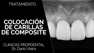 Carillas de composite en Propdental [upl. by Allicserp]