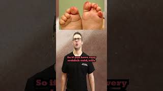 Raynauds Syndrome When Your Toes Hands or Feet Turn Red or White [upl. by Assilev]