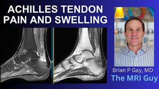 Achilles tendon pain [upl. by Nyllij]