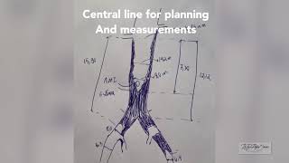 Revascularização Endovascular Aortoilíaca por isquemia de pernas [upl. by Komsa]