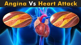 Angina Vs Heart Attack 3D Animation [upl. by Tybald289]