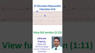 ST Elevation Myocardial Infarction ECG [upl. by Gualterio61]