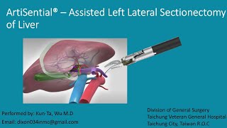 Artisential  assisted Left Lateral Sectionectomy [upl. by Suez]