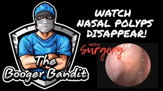 Watch nasal polyps disappear with surgery [upl. by Euqirrne]