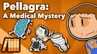 Pellagra  A Medical Mystery  Extra History [upl. by Castle]