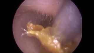 262  Fully occluding and impacted Oily Ear Wax Removal by Ear Microsuction [upl. by Olumor42]