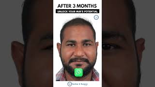 Best Hair Transplant Clinic In India  Hairfree amp Hairgrow Clinic [upl. by Latonia]