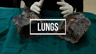 Lungs  gross anatomy [upl. by Lachance]