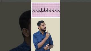 Supraventricular tachycardia ytshorts ecg fmge usmle plab mbbs [upl. by Aicatsanna]