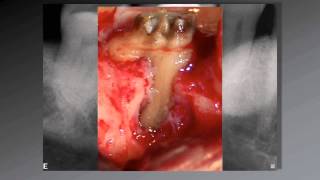 036 El uso de aumento en Endodoncia [upl. by Nowujalo249]