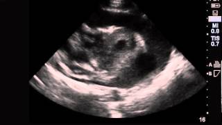 Cardiac Tamponade Ultrasound [upl. by Vtehsta146]