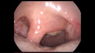 Large Antrochoanal Polyp Causing Nose Block [upl. by Oaht896]