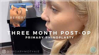 RHINOPLASTY RECOVERY 3 MONTHS POSTOP [upl. by Adnerol]