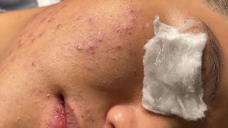 Blackheads amp Pimples Pore Removal New 2024  Acne Treatment With Bo Nguyễn Spa 027 [upl. by Aryk]