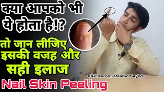 Fingers Skin Peeling Near Nails  Reason And Treatment At Home In Hindi [upl. by Bard]