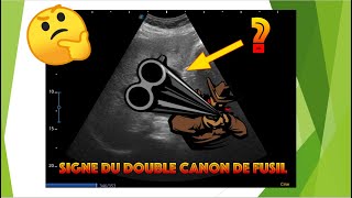 Echographie du cholédoque signe du double canon de fusil [upl. by Havelock]