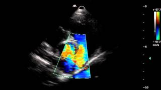 Colour Doppler Echocardiography [upl. by Brownley108]