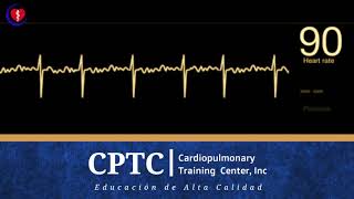 Fibrilación Atrial [upl. by Kamila]